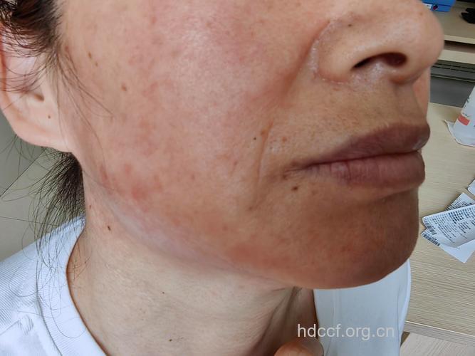 更年期皮肤出现的皮肤问题