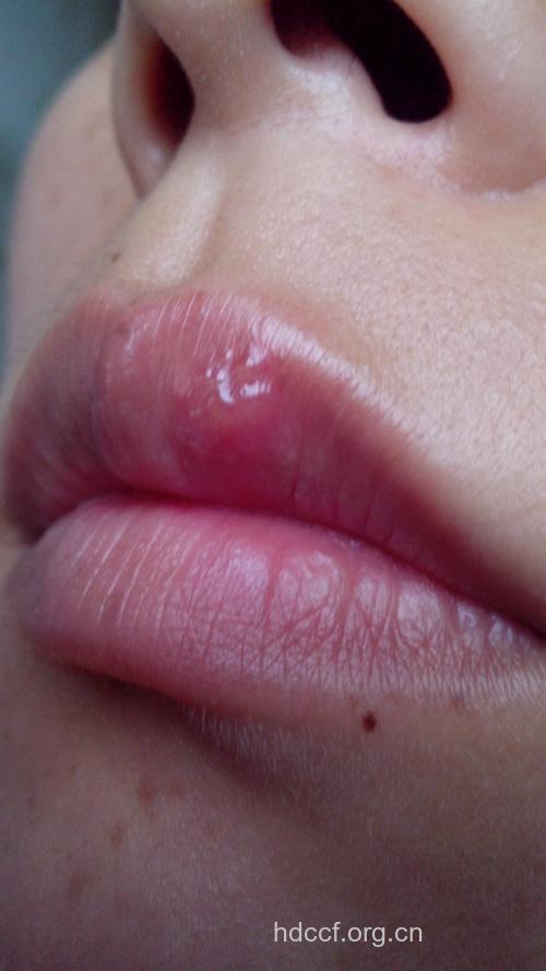 唇疱疹都有哪些类型呢