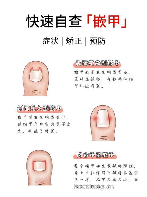 四个小招数帮你轻松防嵌甲