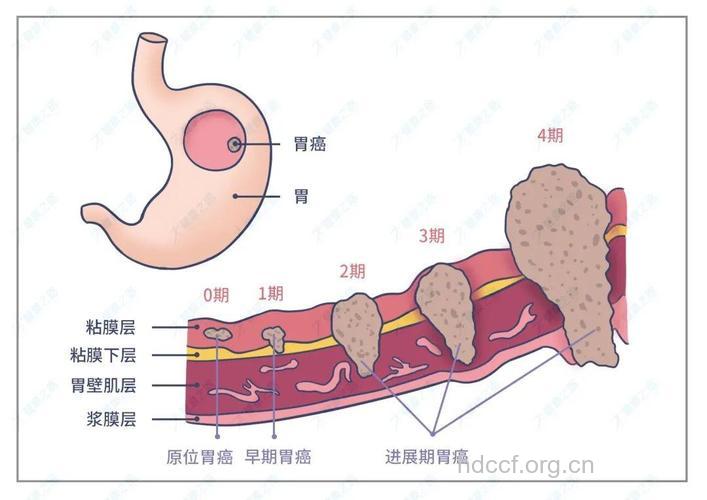 胃癌发病部位的结构解剖
