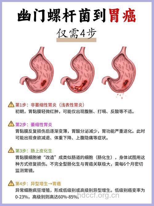 治疗早期胃癌的方法有哪些