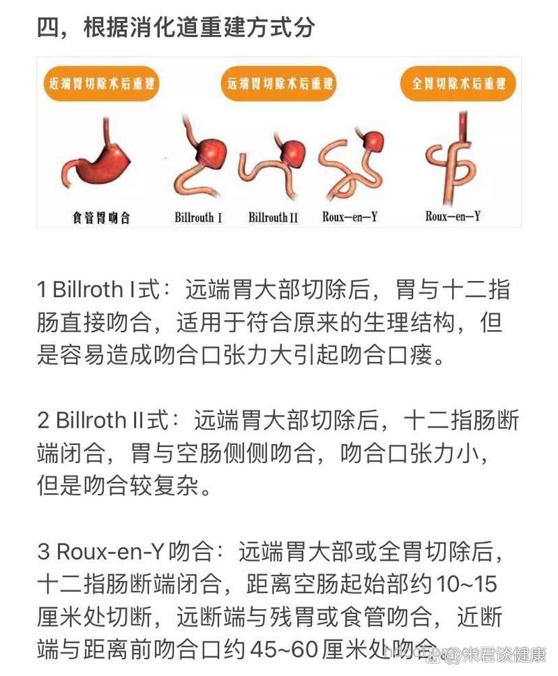 胃癌患者如何选择合理手术方式