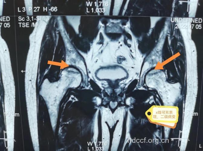 看懂股骨头坏死影像学表现？