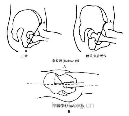 布莱恩特三角检查