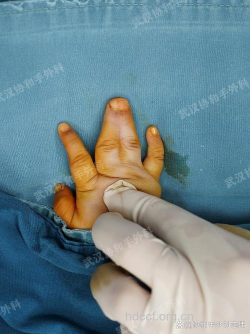 并指(趾)畸形检查