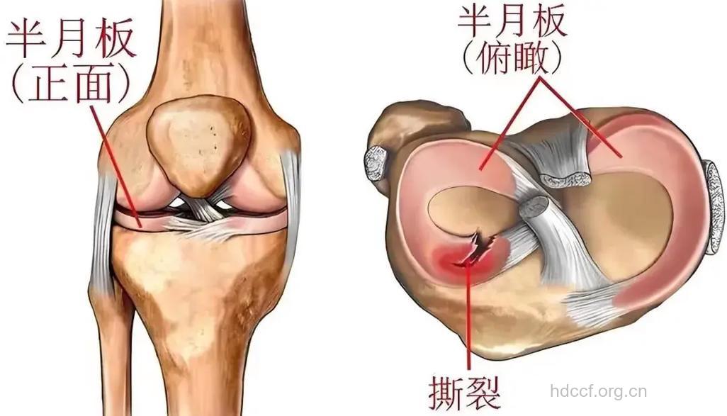 什么是半月板损伤的体征?