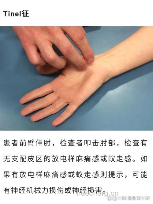 了解什么是Tinel征?