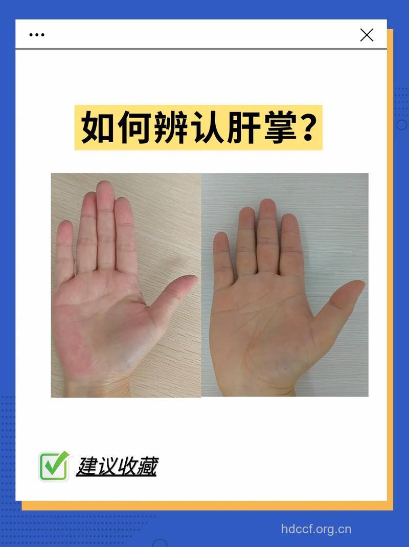 肝掌、蜘蛛痣与肝病的关系