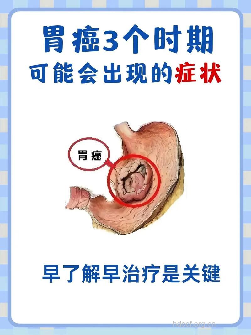 胃癌早期有哪些预警症状