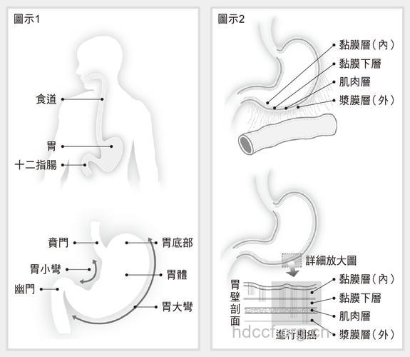 怎么手术方法可治疗胃癌