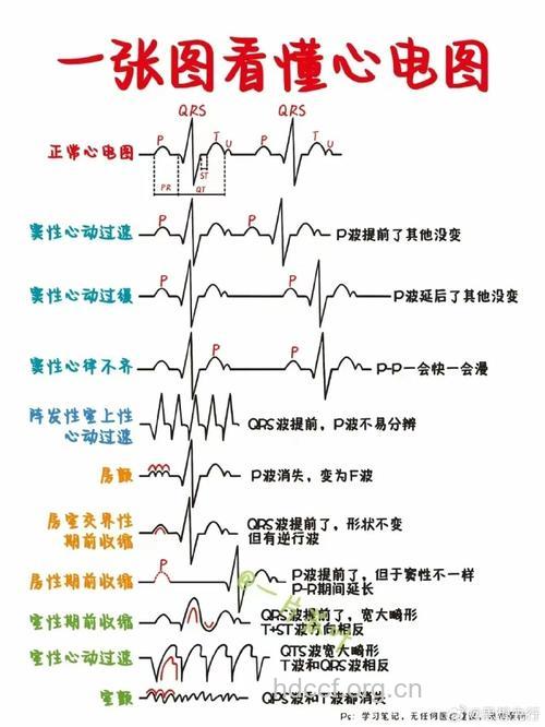 怎么看心电图的难懂符号呢