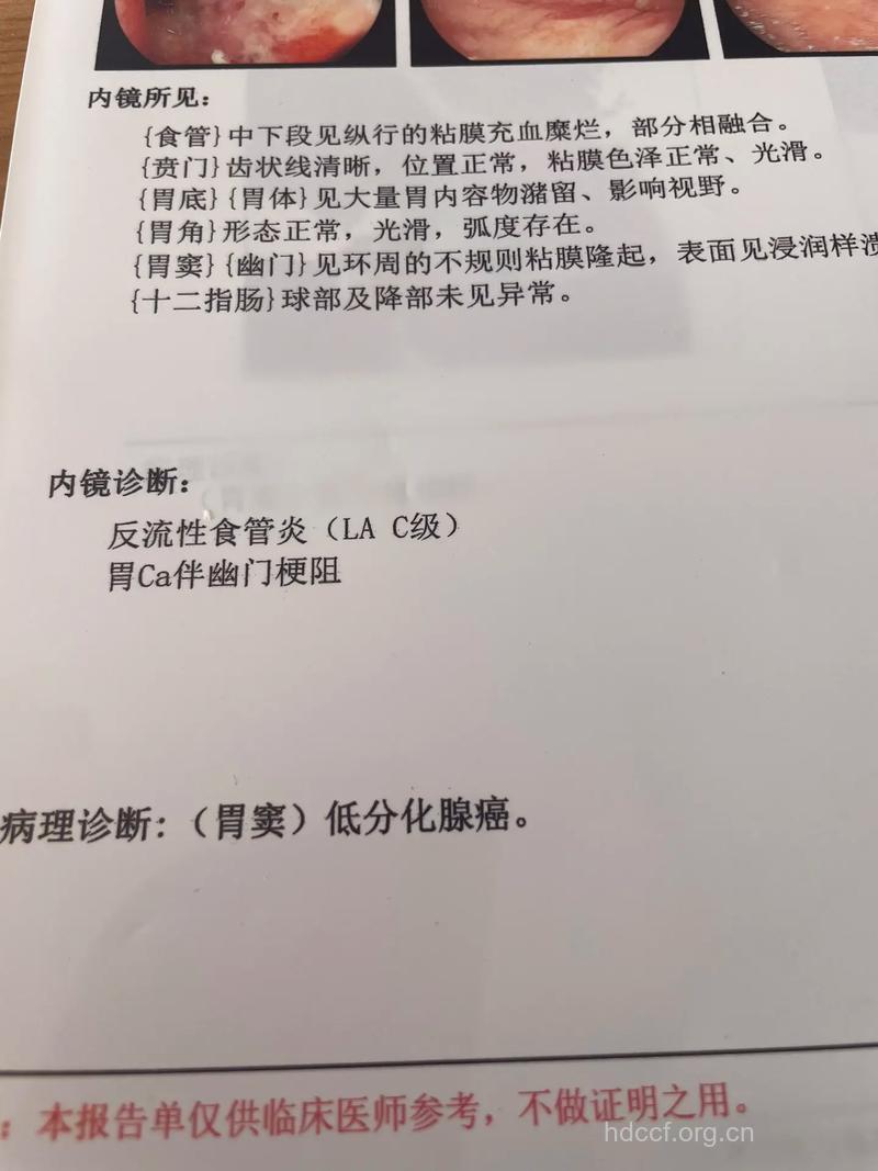 胃癌早期有哪些诊断标准