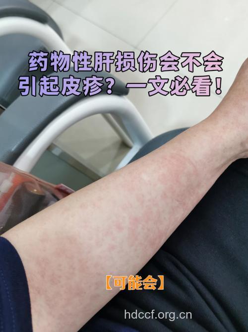 药物性肝炎的基本症状