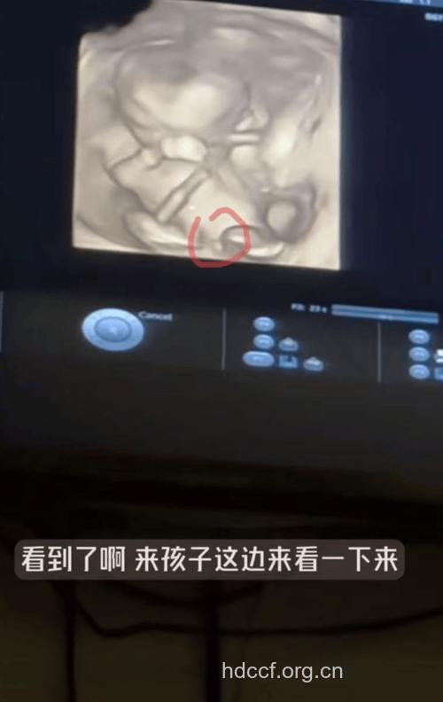 B超报告 看宝宝健康