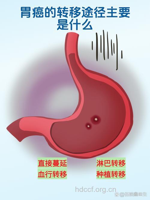 胃癌有几种转移方式