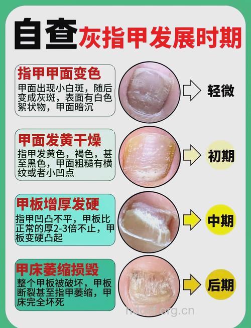 灰指甲诊断方法 我们该如何预防