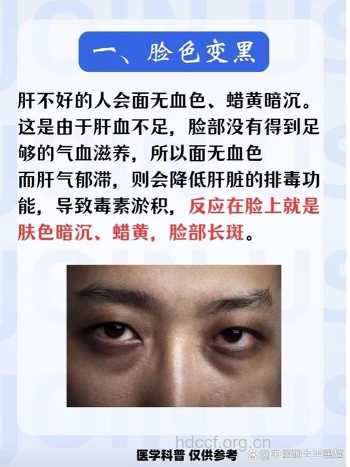 乙肝患者会出现黑眼圈症状吗