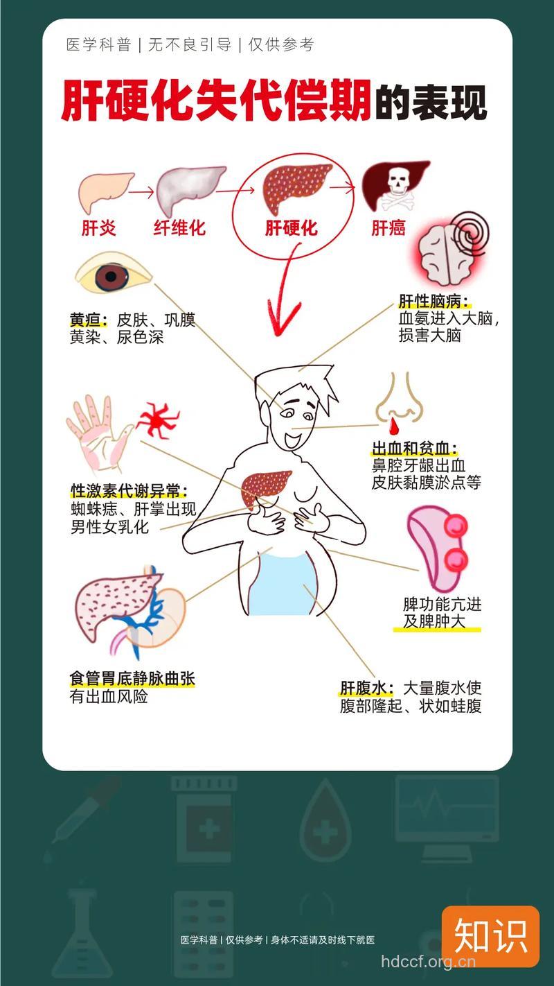 肝硬化失代偿的症状表现