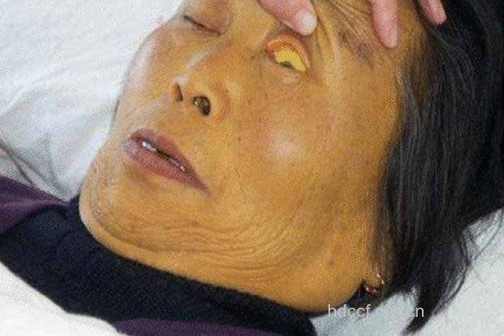 老年乙肝病人的症状表现