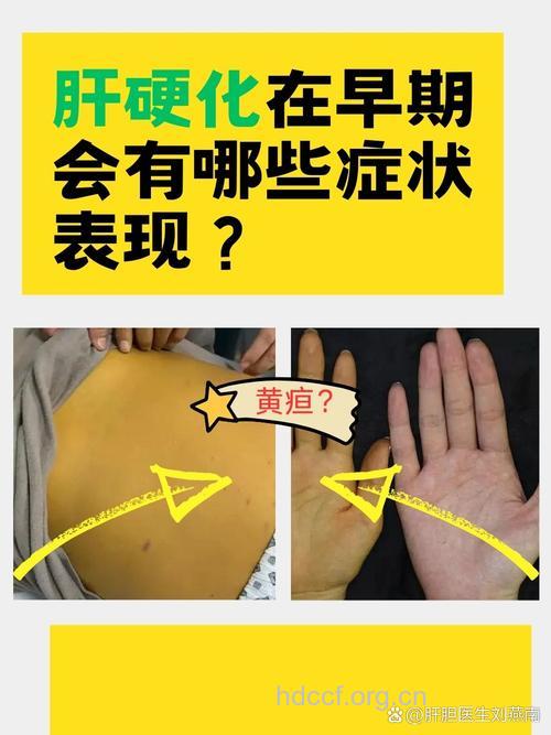 肝硬化早期的症状表现