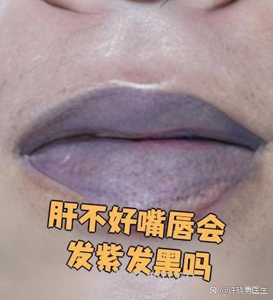 嘴唇发黑是不是乙肝的症状