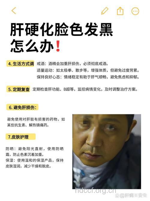 面部发黑是肝硬化的症状吗