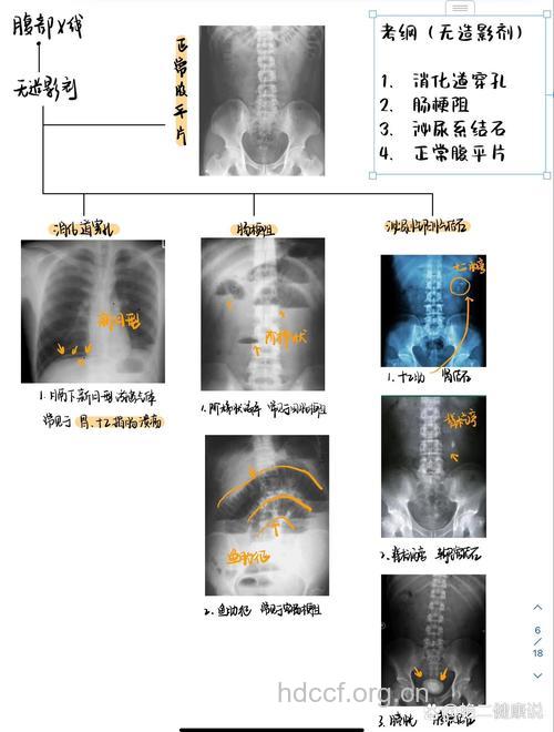 腹部平片检查需要注意什么