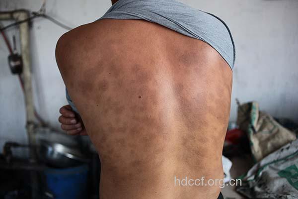 慢性丙肝晚期的症状