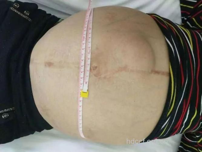 肝硬化腹水晚期症状有哪些