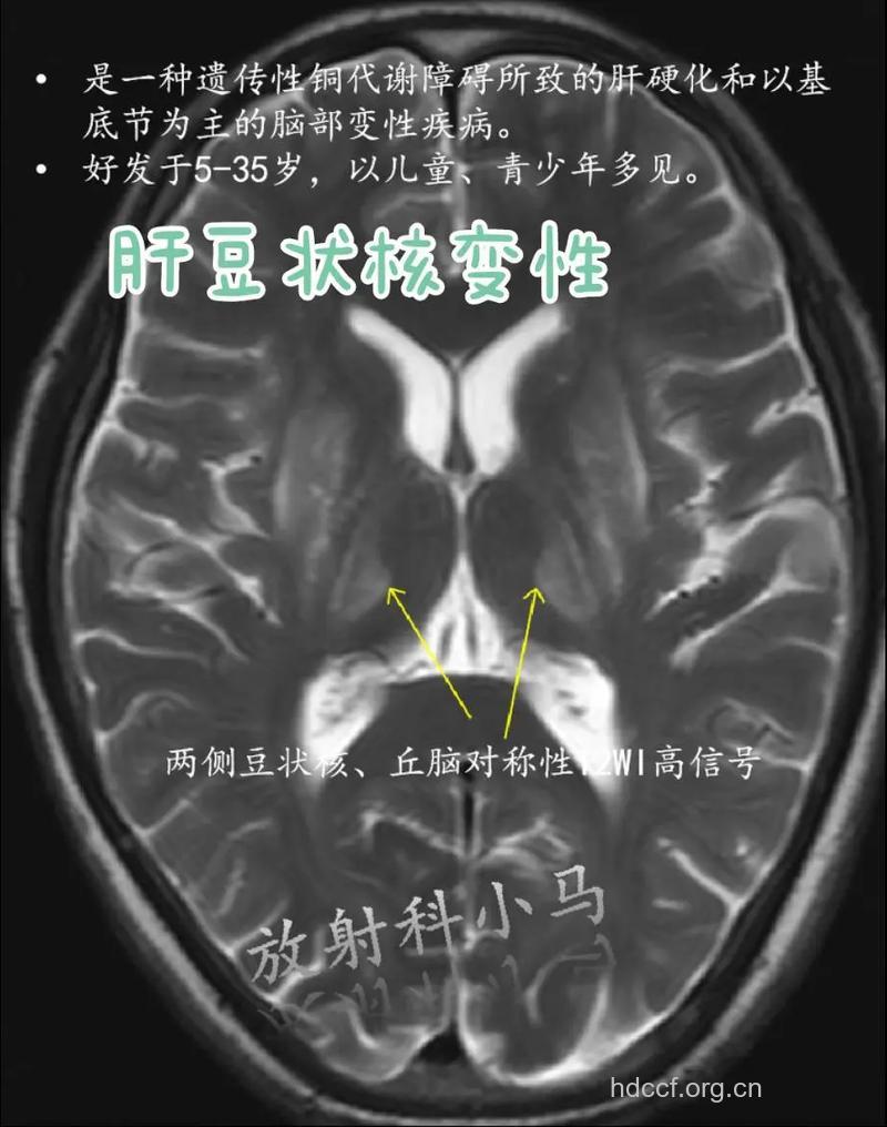 肝豆状核变性的症状表现是什么