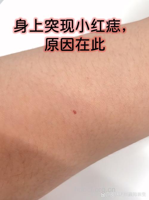 乙肝病毒携带者为什么会长蜘蛛痣