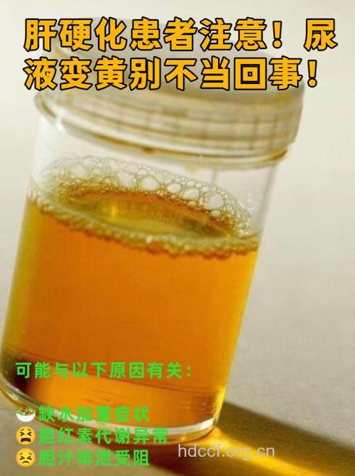 小便发黄是乙肝症状吗