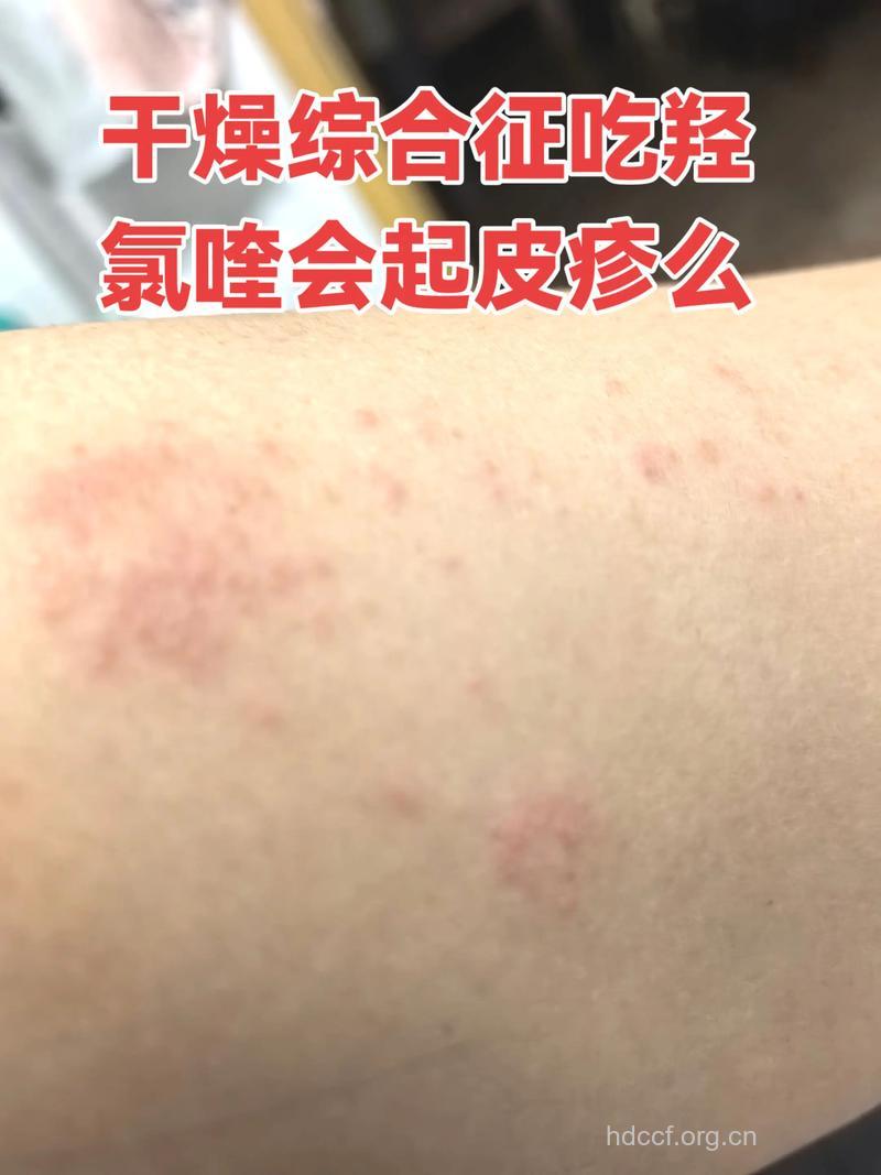 皮肤干燥有可能是乙肝的症状吗