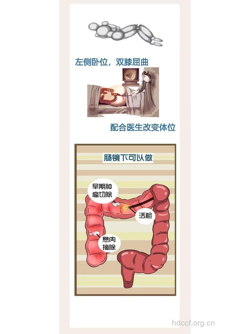 怎么进行纤维结肠镜检查