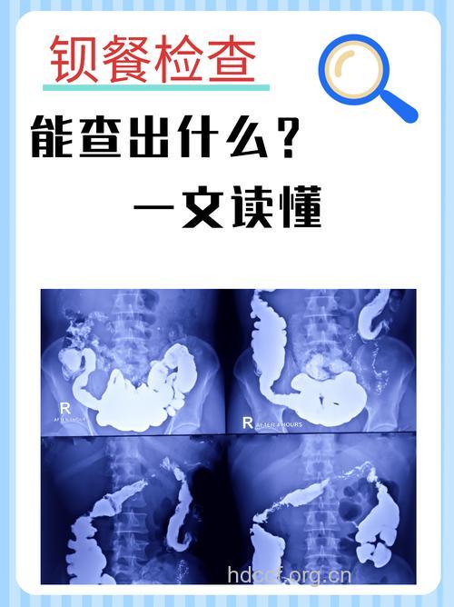 怎么进行钡灌肠X线检查