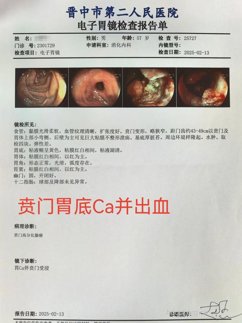 胃癌引起的胃出血怎么治疗呢