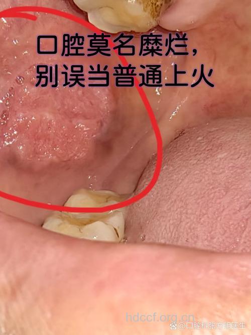 乙肝患者会出现口腔溃疡吗
