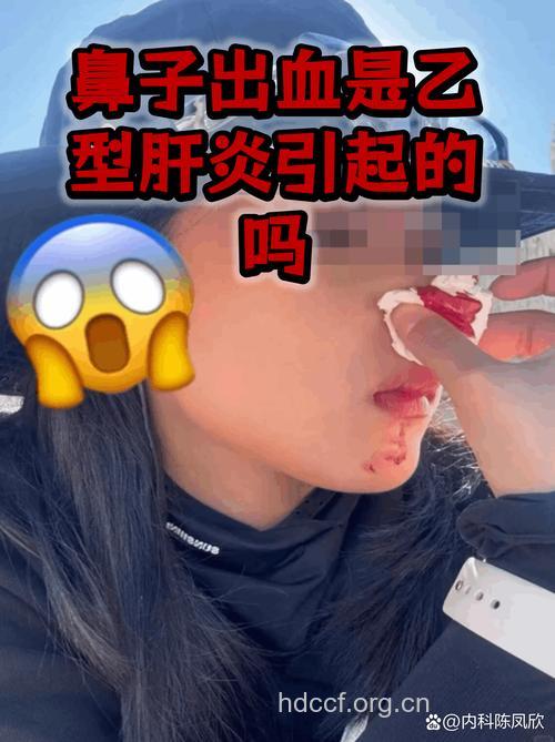 流鼻血是乙肝的症状吗