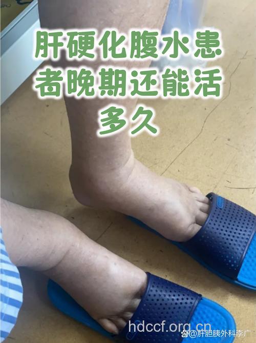 肝硬化晚期的症状