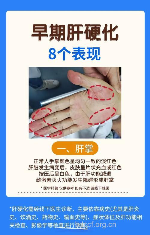 肝病早期的症状是什么