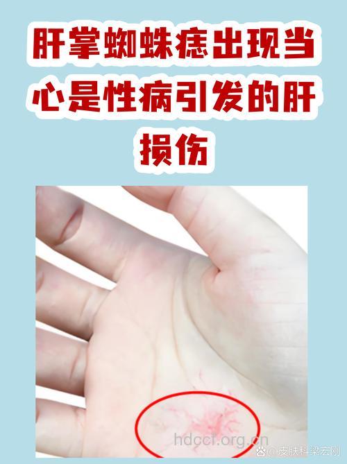 肝掌蜘蛛痣是肝纤维化症状吗