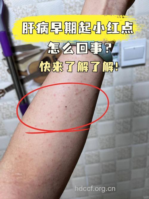 哪些皮肤症状是得了肝病