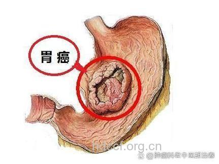 胃癌患者术胃瘫的原因有哪些呢