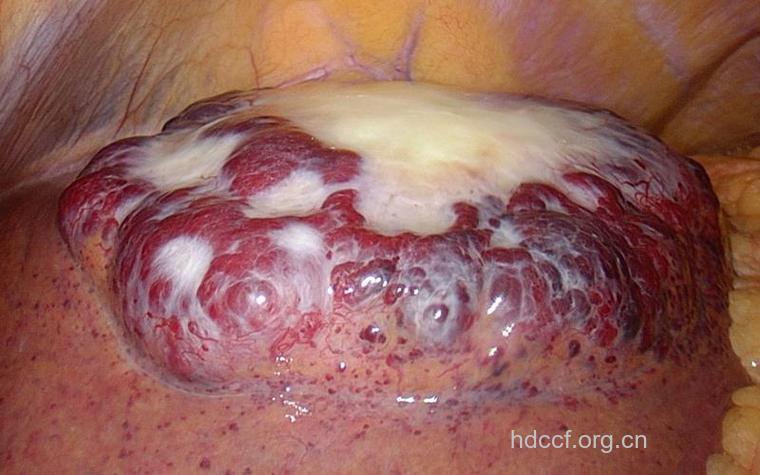 肝血管瘤症状是什么