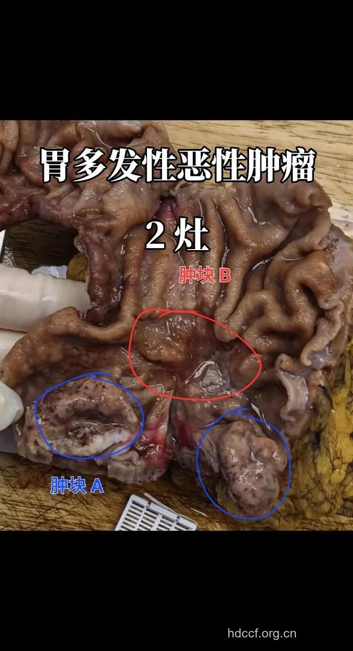 胃癌症状会有哪些呢