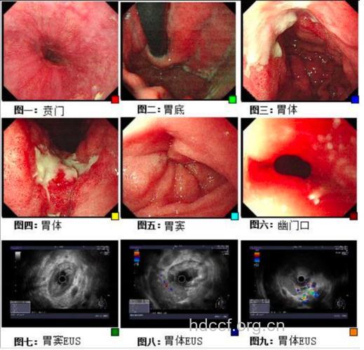 胃癌的胃外表现有什么呢