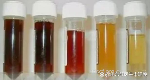 早晨第一泡尿 看出你的肝状况