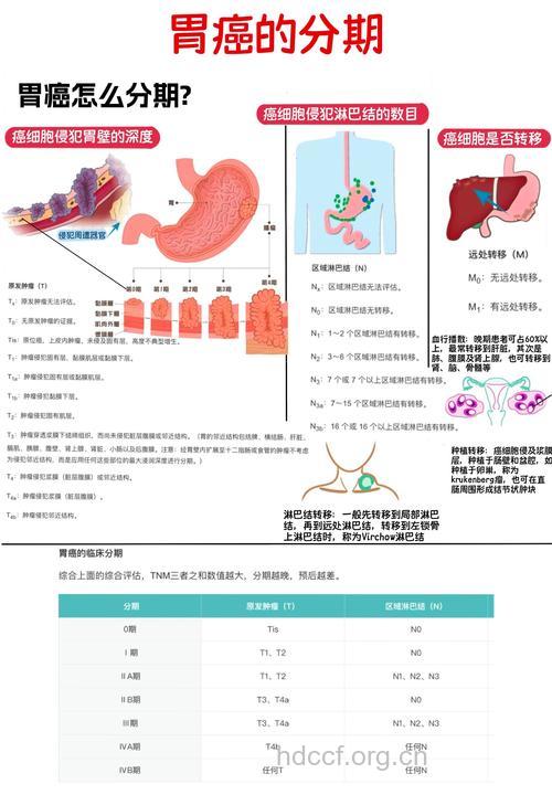 日常生活怎么分期治疗胃癌方法