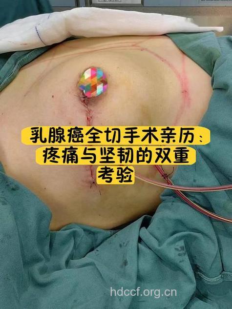 太早做乳腺造影小心得乳癌