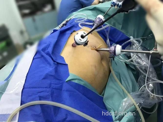 专家解析：腹腔镜检查全过程